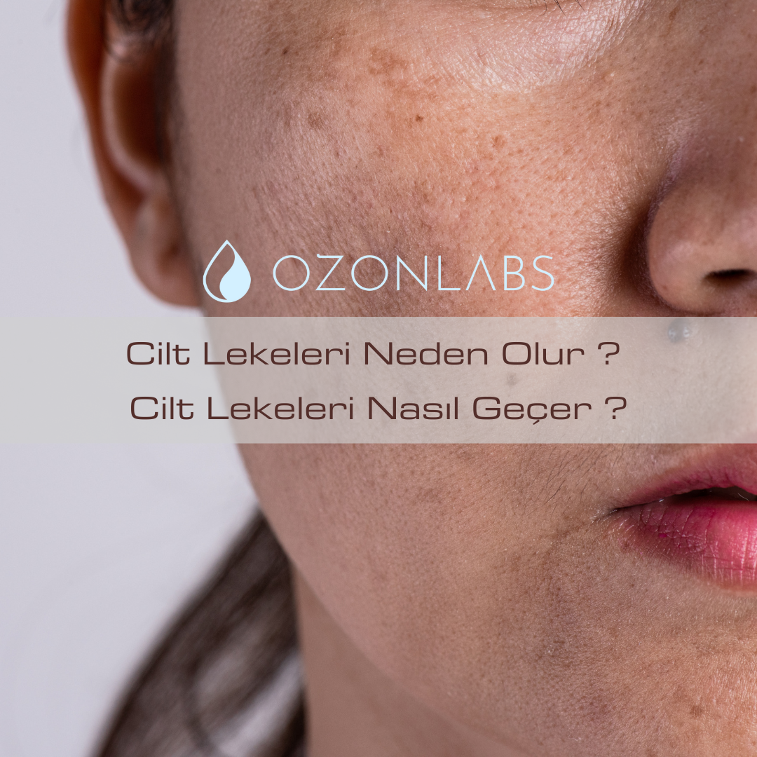Cilt Lekeleri Neden Olur? Cilt Lekeleri Nasıl Geçer?