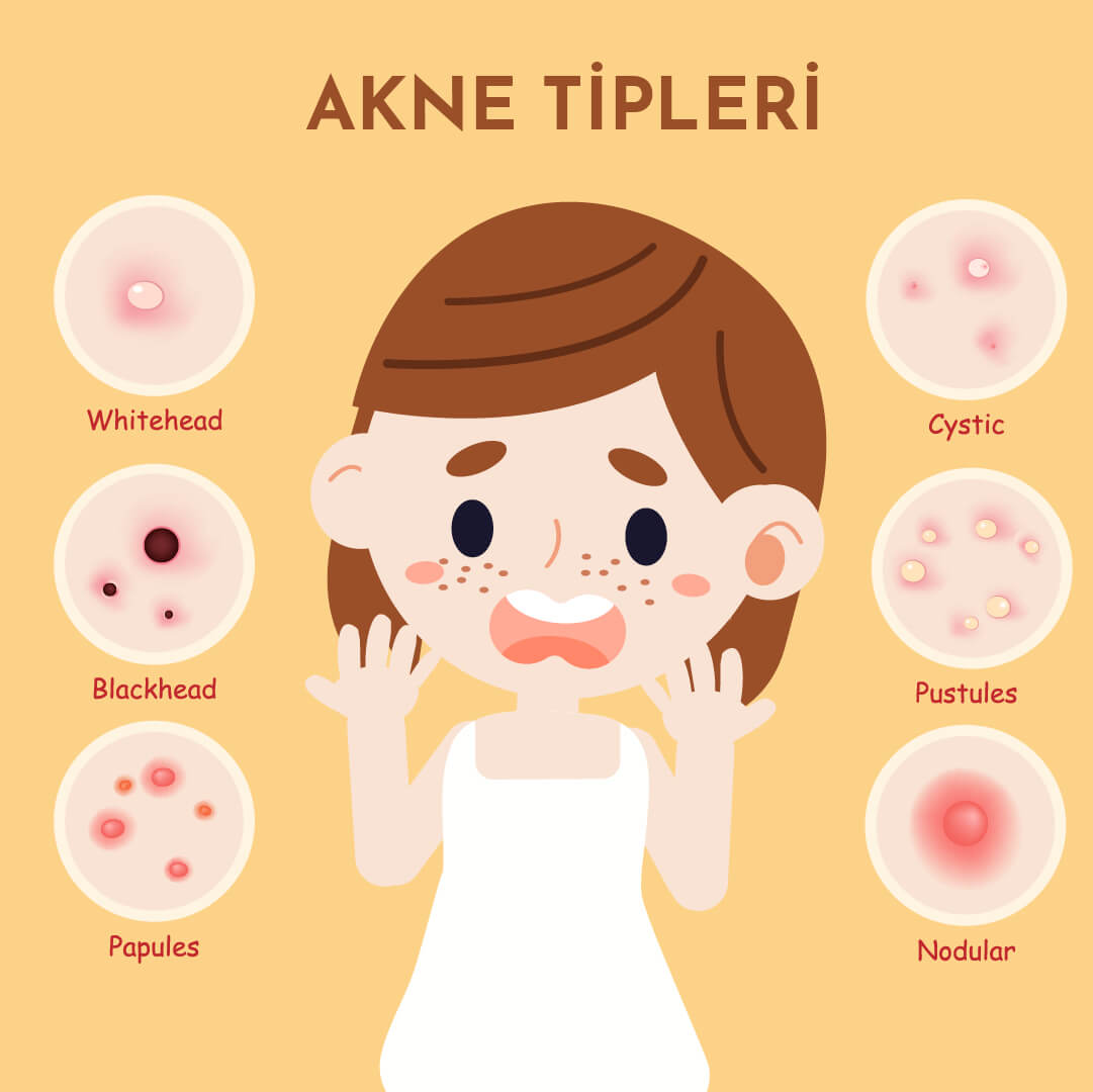 Ozonlabs Akne Rosacea Gül Hastalığı Madalyon Hastalığı Tedavisi Belirtileri