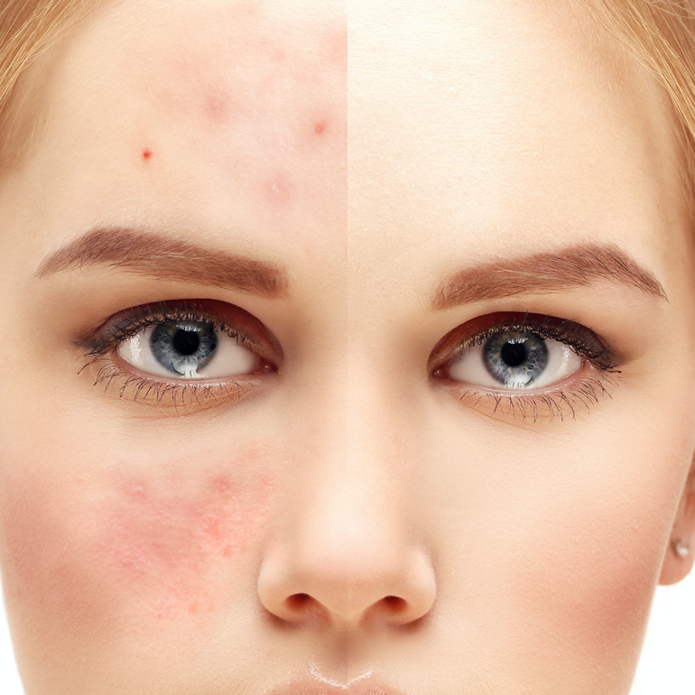 Rozalı ciltlerde maske kullanımı nasıl olmalı?